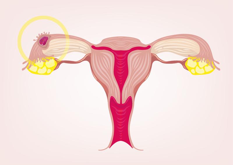 Ilustração de uma gravidez ectópica destacando a localização do óvulo fertilizado fora do útero