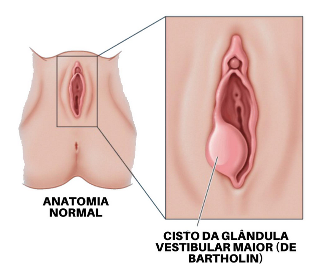 A glândula de Bartholin inflamada (bartolinite)
