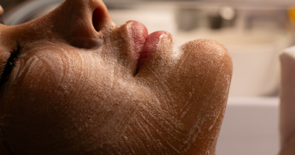 Paciente recebendo orientação sobre os riscos da isotretinoína para rejuvenescimento da pele